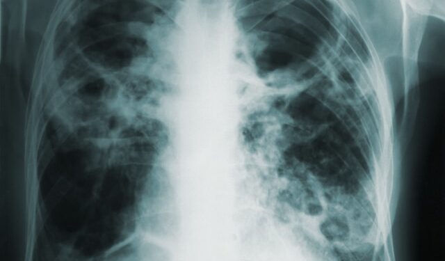 Tuberculosis