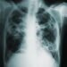 Tuberculosis